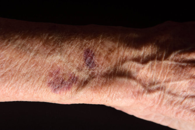 Easy Bruising in Seniors and How to Prevent It